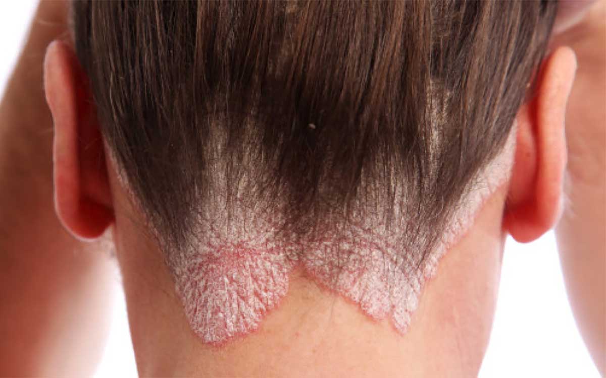 psoriasi cura omeopatica psoriasi cura omeopatica